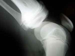 knee-arthritis-01.jpg