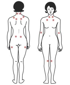 Relieve fibromyalgia with acupuncture